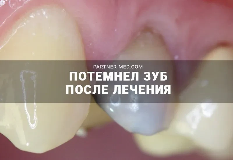Потемнел зуб