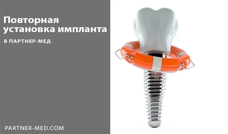 Повторная имплантация зуба Повторная имплантация зуба