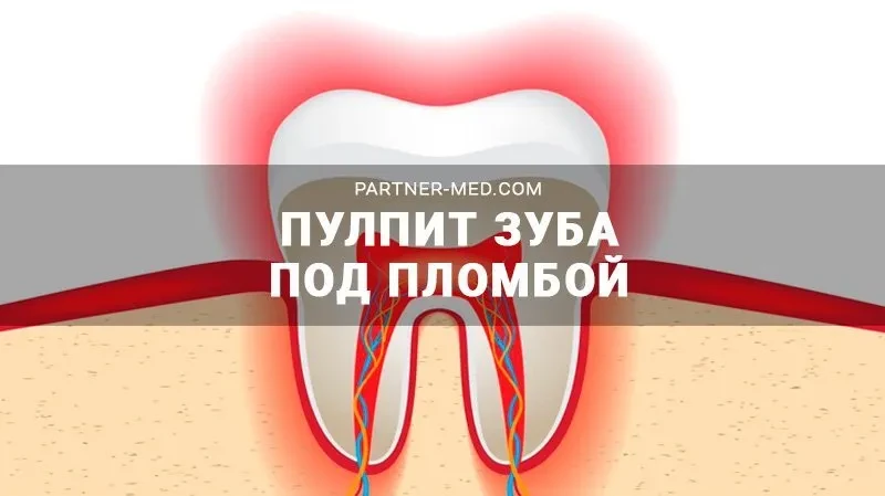 Пульпит зуба под пломбой