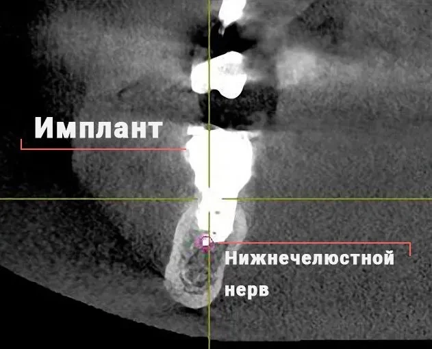 Онемение после имплантации Онемение после имплантации