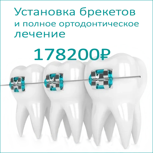 Лечение открытого прикуса у взрослых