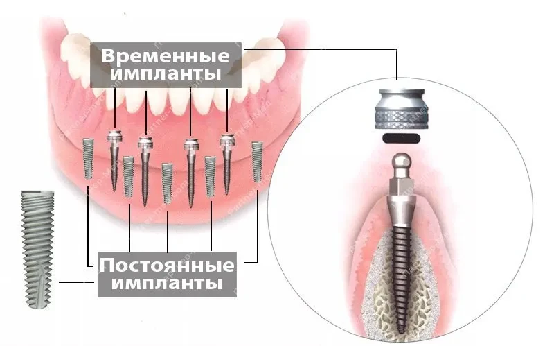 Временные импланты зубов Временные импланты зубов