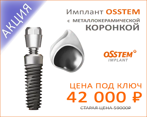 Одномоментная имплантация зубов Одномоментная имплантация зубов