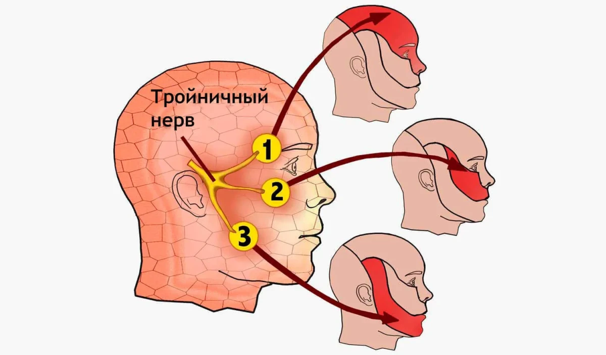 Воспаление тройничного нерва: как лечить?