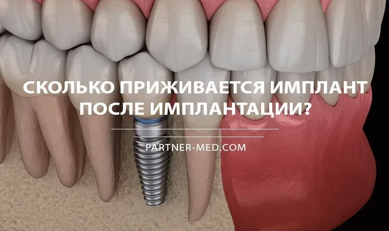 Сколько приживается зубной имплант? Сколько приживается зубной имплант?