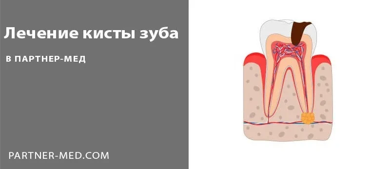 Можно ли сохранить зуб с кистой на корне?