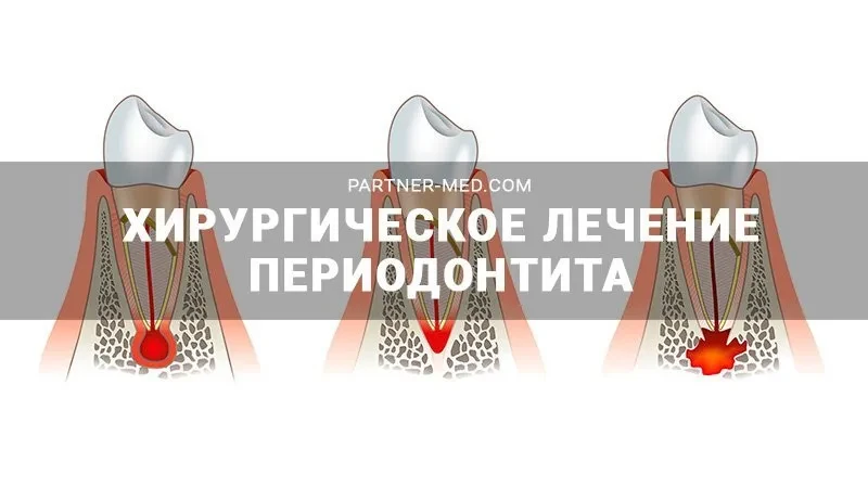 Хирургическое лечение периодонтита