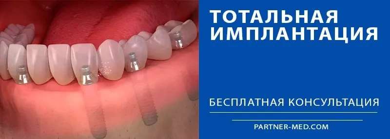 Тотальная имплантация зубов Тотальная имплантация зубов