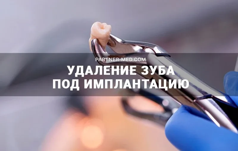 Удаление зуба под имплантацию Удаление зуба под имплантацию