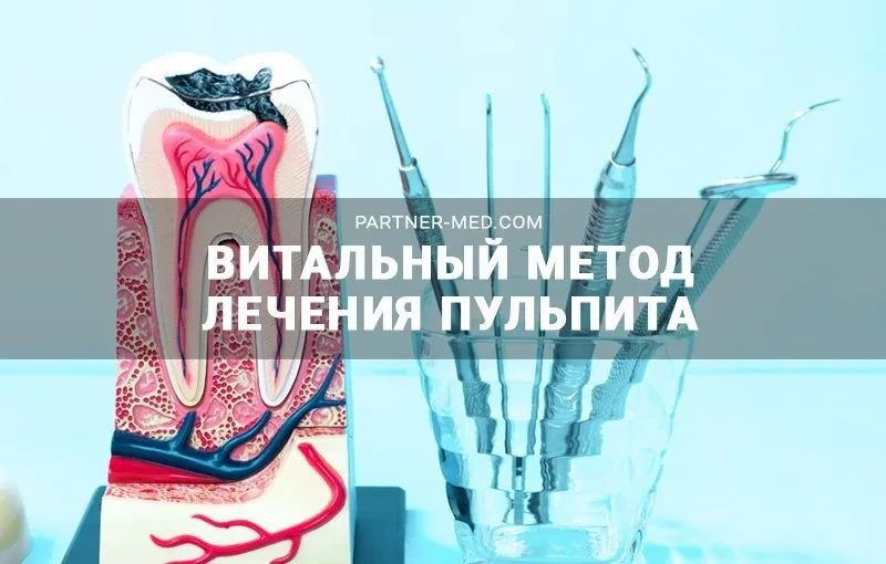 Витальный метод лечения пульпита