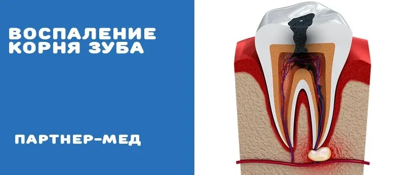 Воспаление корня зуба