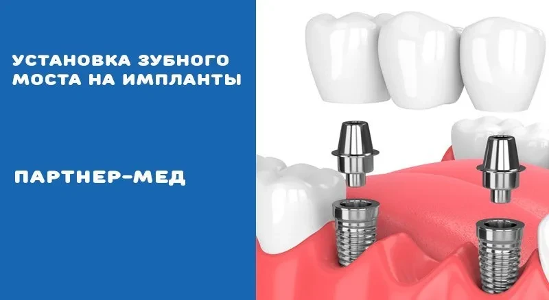 Зубные мосты на импланты Зубные мосты на импланты