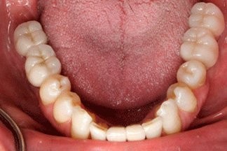 Имплантация жевательных зубов на имплантах Штрауманн