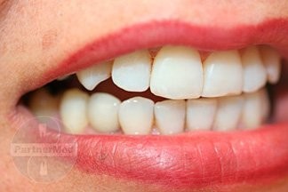 Имплантация одного зуба на импланте Астра Тек